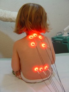 Laser needle acupuncture perfomed on a young child, taken from The Laserneedle Therapy Handbook by Dr. Detlef Schikora / Rita Klowersa / Prof. Sandi Suwanda. 2012.